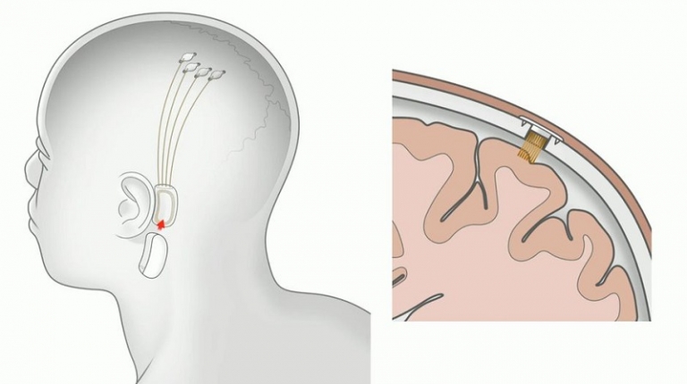 Elon Musk announces plans to put microchips into brains by next year